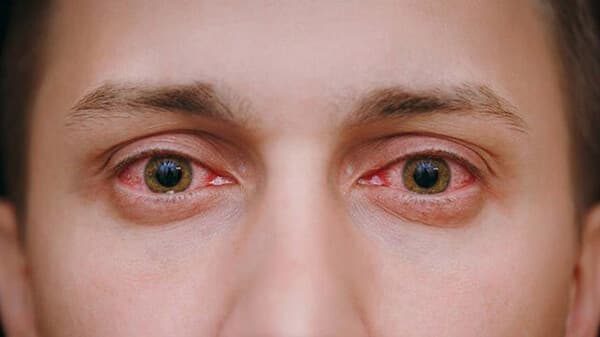 Giác mạc có thể bị tổn thương nếu không tháo lens trước khi đi ngủ
