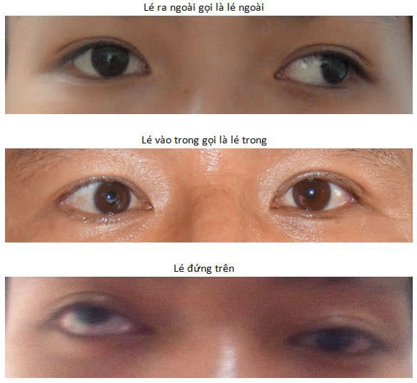 Triệu chứng của mắt lác