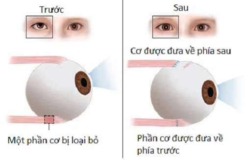 Mắt lác có chữa được không?