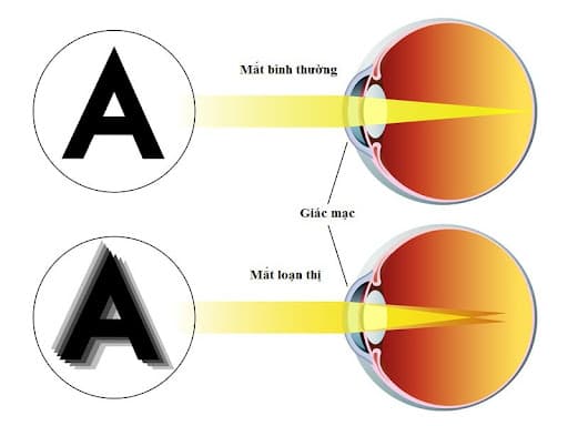 Loạn thị là tình trạng nhìn các vật bị nhoè, vật có nhiều bóng mờ