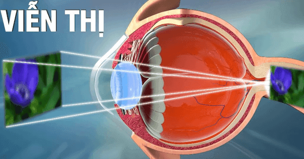 Viễn thị bẩm sinh xuất hiện từ khi trẻ còn rất nhỏ