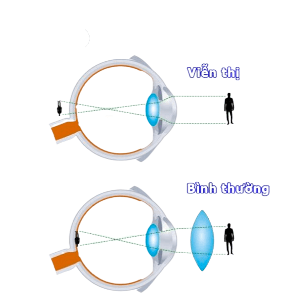 Nhiều người bị viễn thị do cấu tạo mắt tự nhiên
