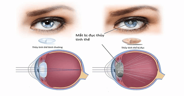Bệnh đục thuỷ tinh thể thường xuất hiện ở người già