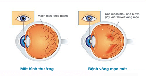 Bệnh võng mạc tiểu đường xuất hiện ở người bị bệnh tiểu đường