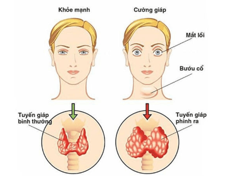 Bệnh cường tuyến giáp có triệu chứng là mắt bị lồi