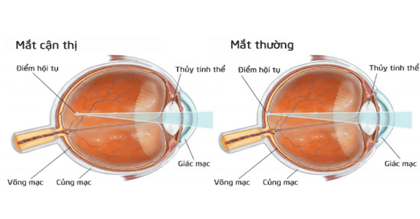 Cận thị là hiện tượng hình ảnh hội tụ trước võng mạc