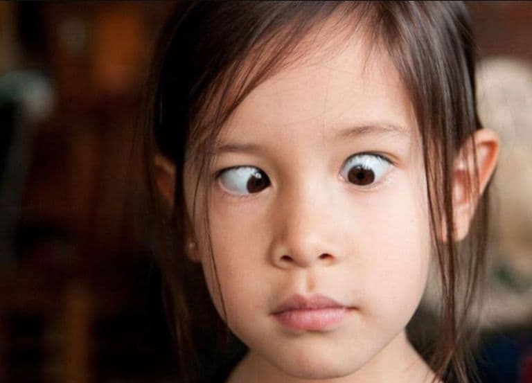Mắt lác là gì? Nguyên nhân và Cách kiểm tra mắt lác đơn giản