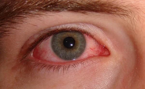 Không nên đeo lens khi bạn đang gặp vấn đề về mắt