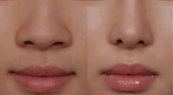 Khuôn mặt có mũi to là mũi có kích thước mũi lớn hơn bình thường và lớn hơn so với tỉ lệ khuôn mặt