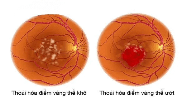Bệnh thoái hoá điểm vàng thể khô thường phổ biến hơn