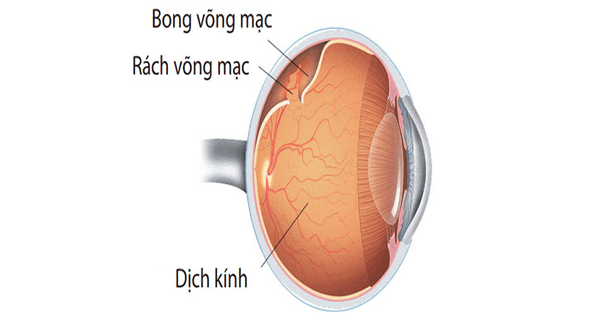 Bệnh bong võng mạc khá nguy hiểm cho mắt
