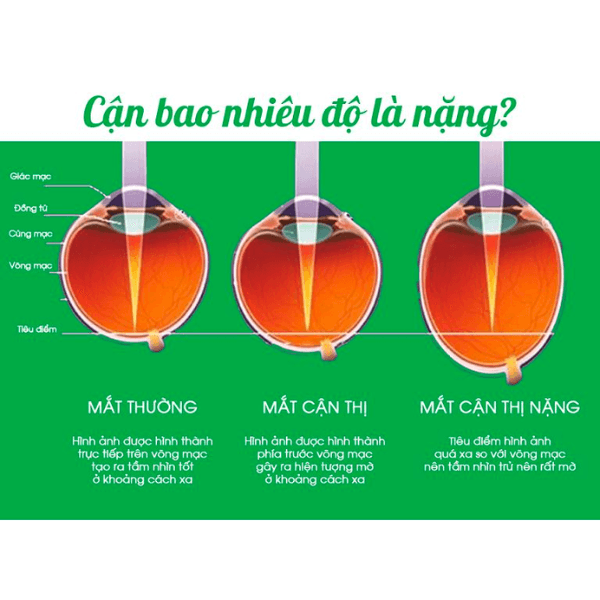 Hình ảnh minh hoạ cho mắt bị cận thị từ nhẹ đến nặng