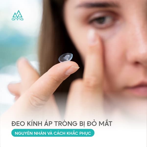 Đeo Kính Áp Tròng Bị Đỏ Mắt – Nguyên Nhân và Cách Khắc Phục